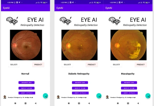 Android app to detect eye diseases